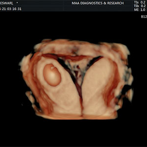 gynaec 3d scans